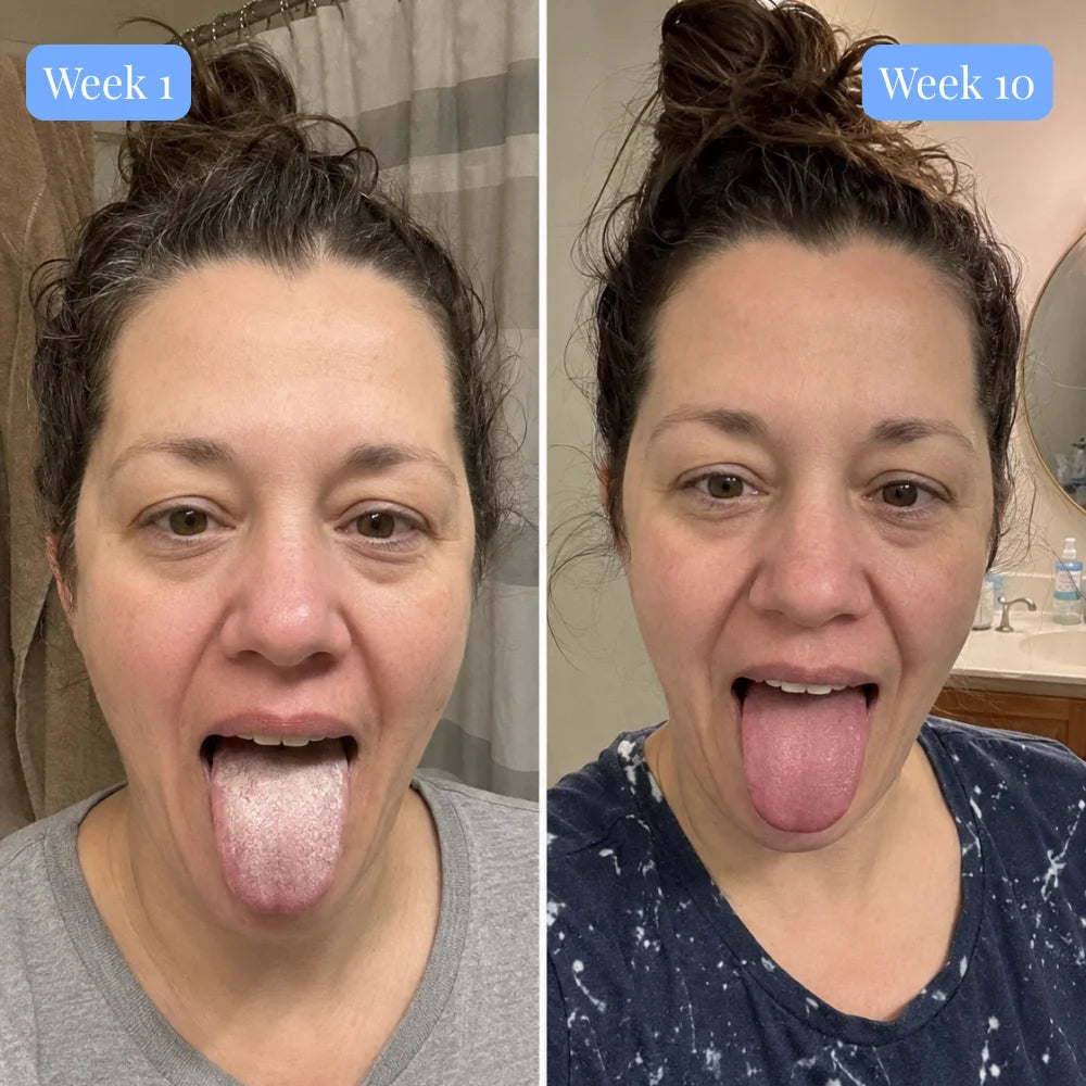 Halori™ Oral Probiotic fix tonsil stones at the source
